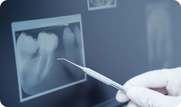 歯のレントゲンの写真